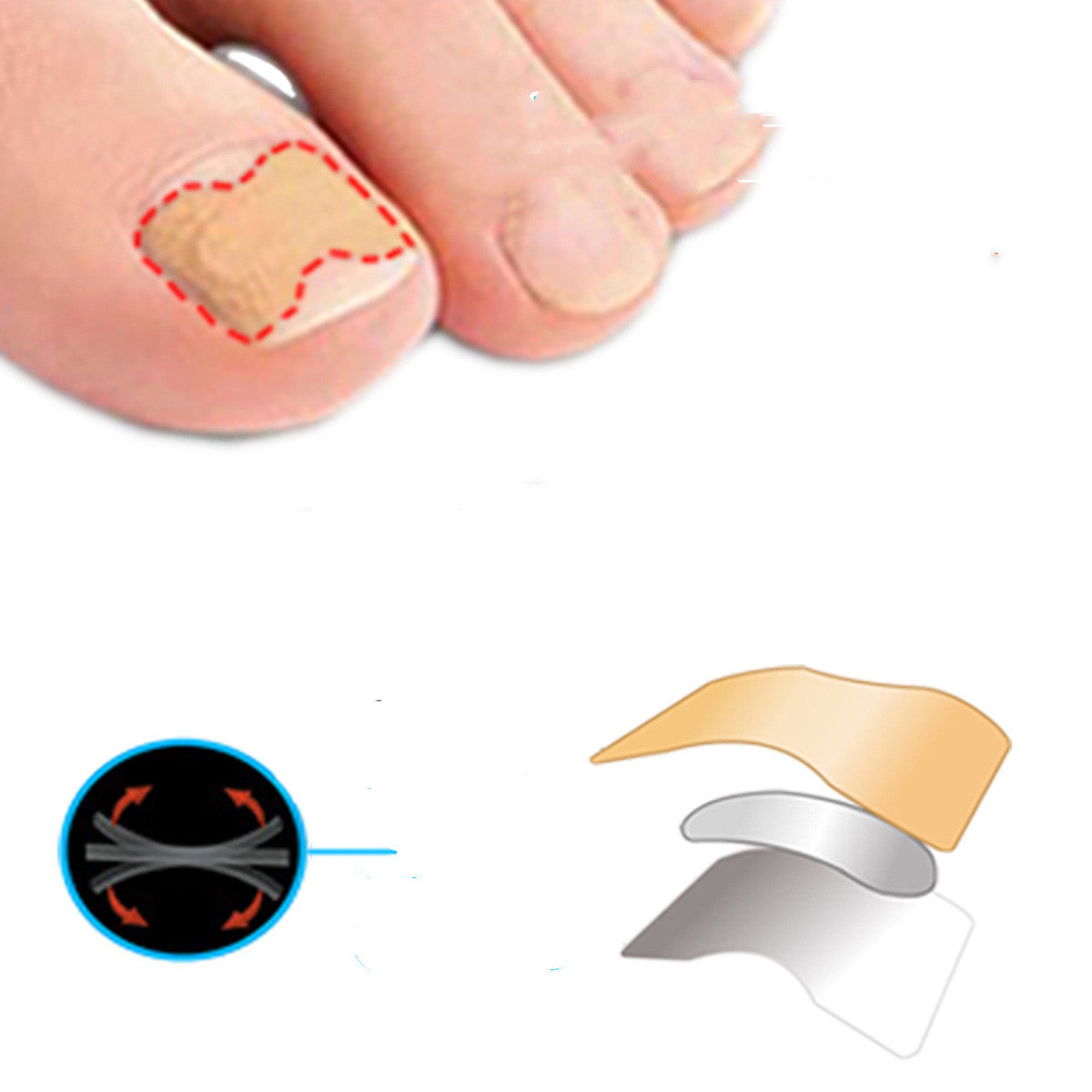 Nail Corrector Patch