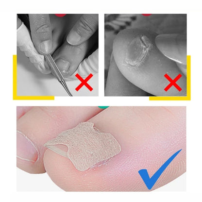 Nail Patch Correction